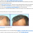 regrow hair offer.png