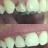 Dental Composites - A Cosmetic Tooth Filling.jpg