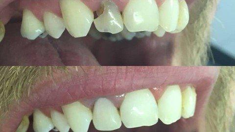 Dental Composites - A Cosmetic Tooth Filling.jpg