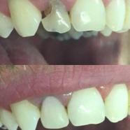 Dental Composites - A Cosmetic Tooth Filling.jpg